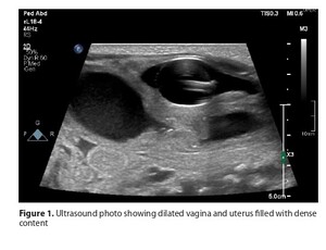 Figure from article: Imperforate hymen with...