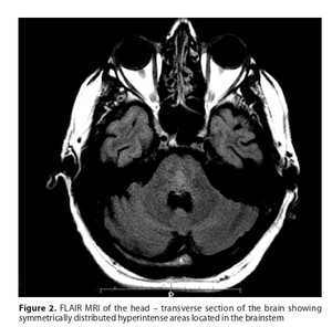 Figure from article: Severe course of osmotic...
