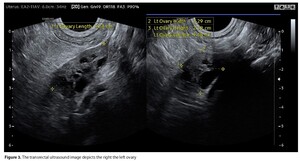 Figure from article: Mayer-Rokitansky-Küster-Ha...
