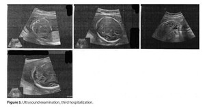 Figure from article: Pregnancy after kidney...