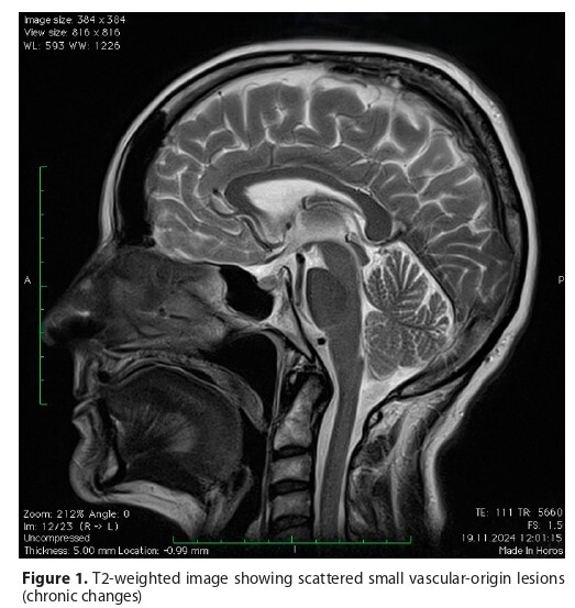 Figure from article: Epileptic seizure after...